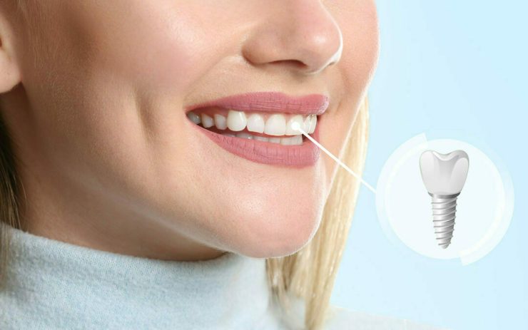 the Fabrication of Tooth Bridges
