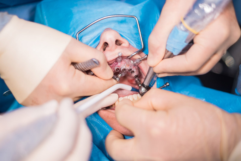 Dental Surgery Procedure