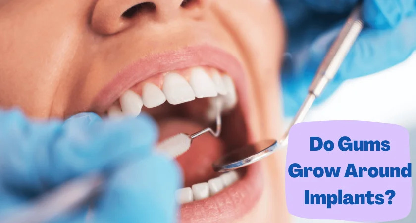Do Gums Grow Around Implants?