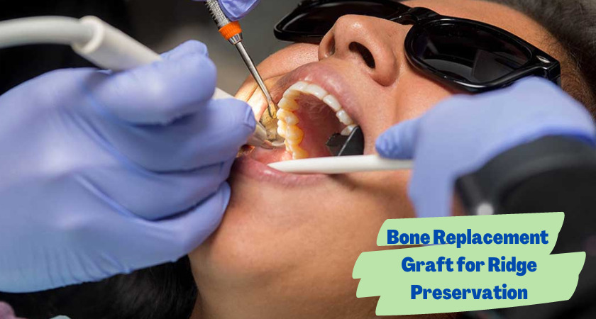 Bone Replacement Graft for Ridge 7 Preservation