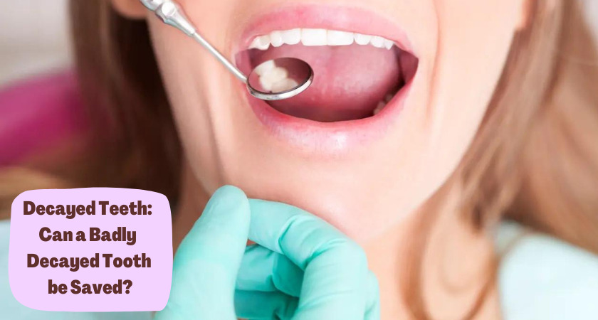 Decayed Teeth: Cana Badly Decayed Tooth be Saved?