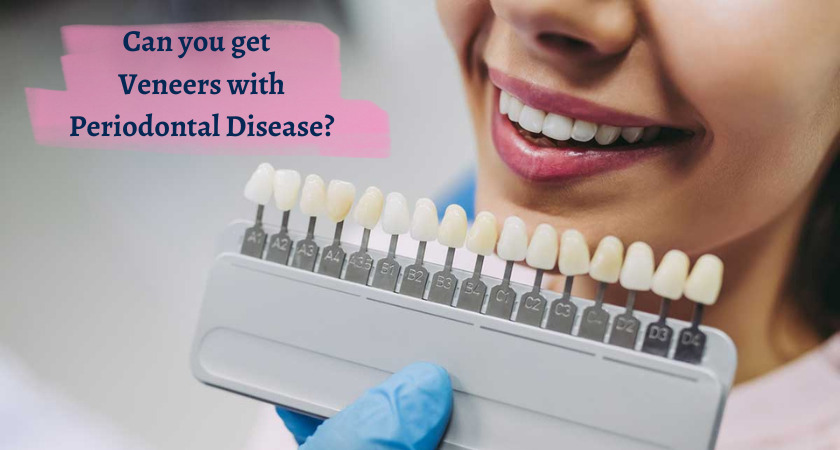 Can you get Veneers with Periodontal Disease?