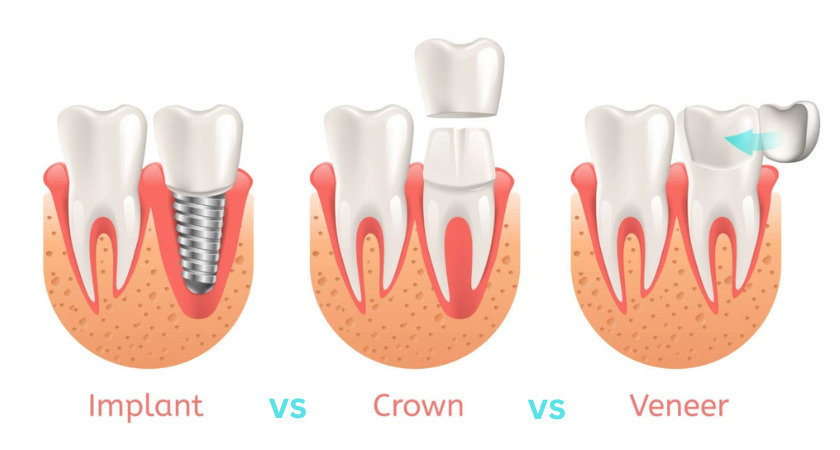 Veneers vs Crowns vs Implants