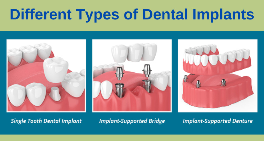 Different Types of Dental Implants