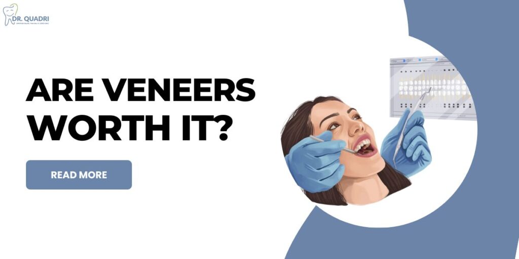 Are Veneers Worth It