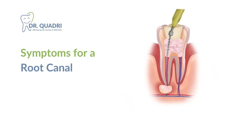 Symptoms for a Root Canal