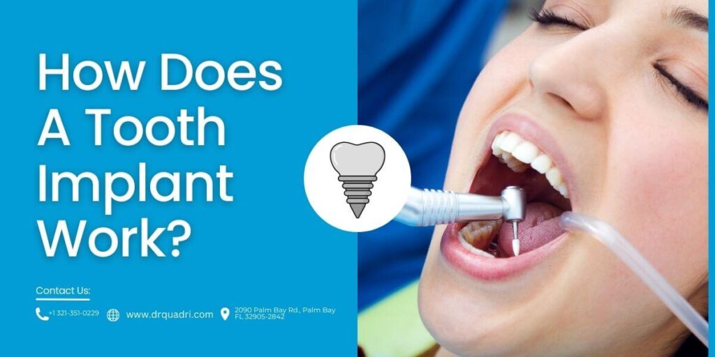 How Does A Tooth Implant Work?
