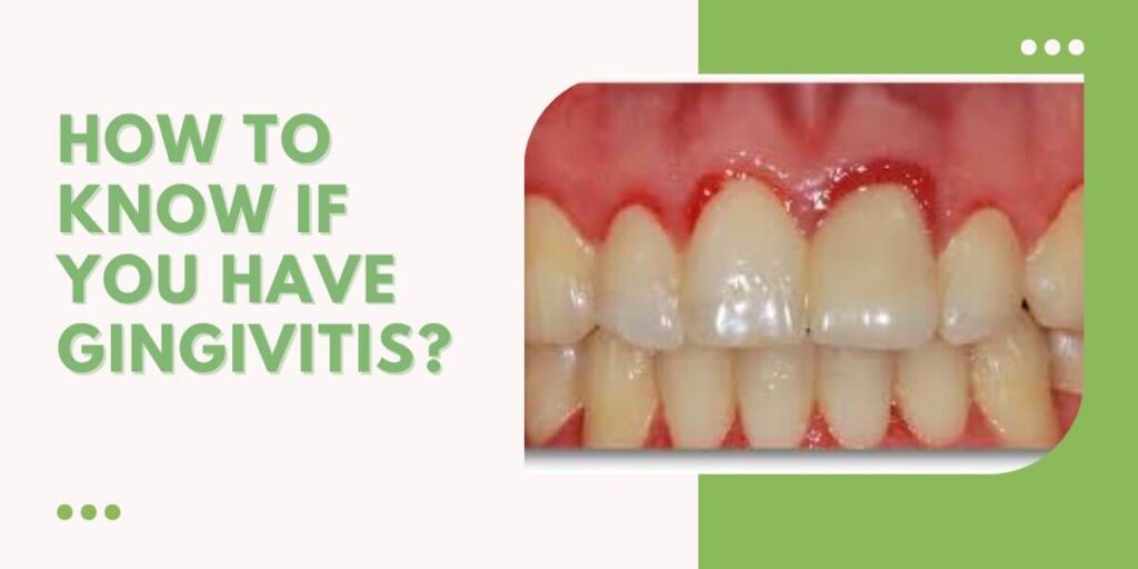 How To Know If You Have Gingivitis (1)