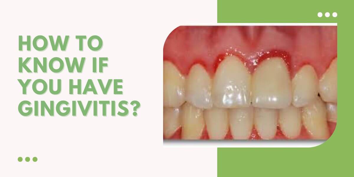 How To Know If You Have Gingivitis (1)