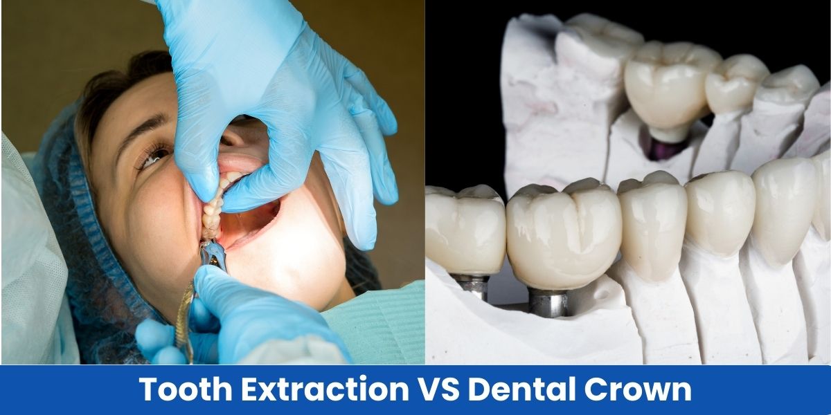 Tooth extraction vs crown