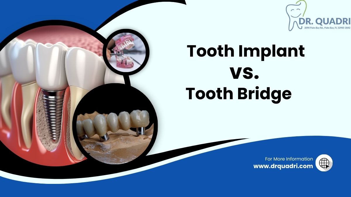 tooth implant or bridge which is better