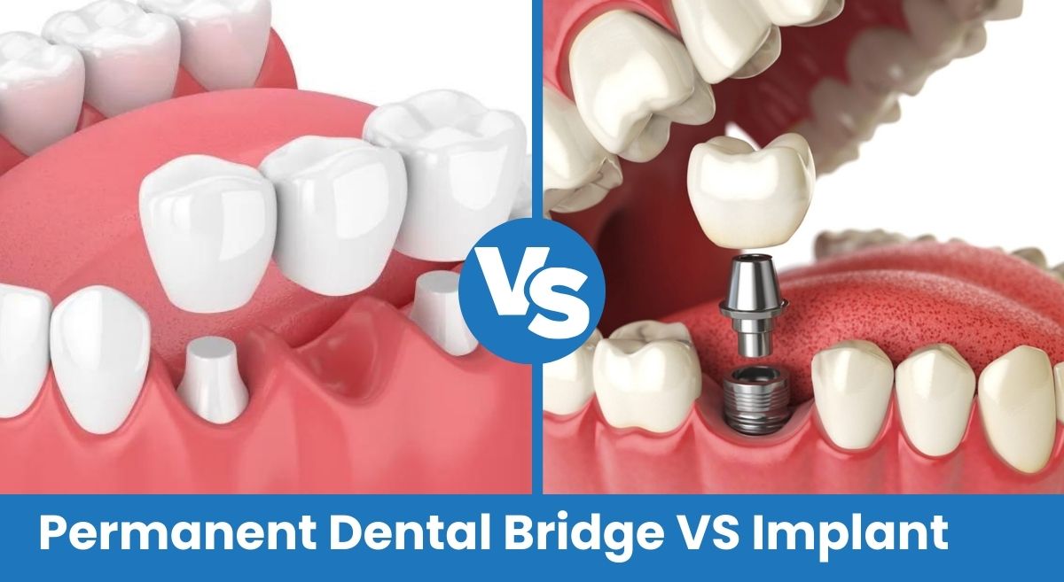 Permanent Dental Bridge VS Implant