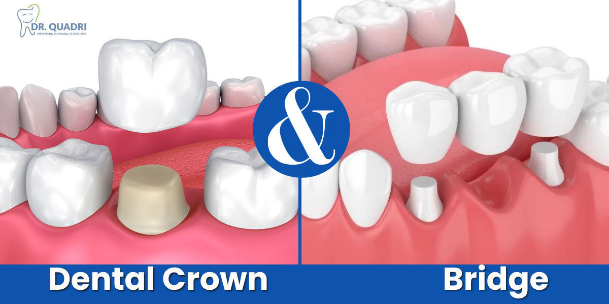 Difference Between Dental Crown and Bridge