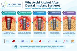 Why You Must Avoid Alcohol After Dental Implant Surgery: A Complete Patient Recovery Guide